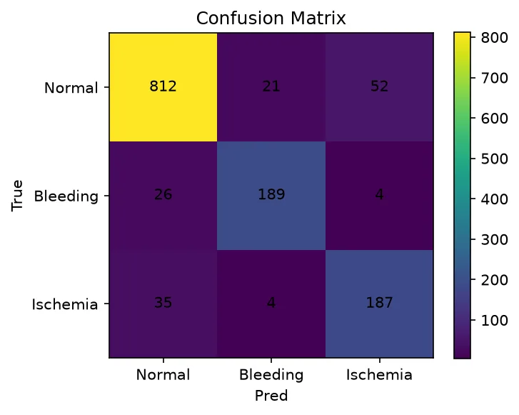 Stroke classifier: confusion matrix on the validation set